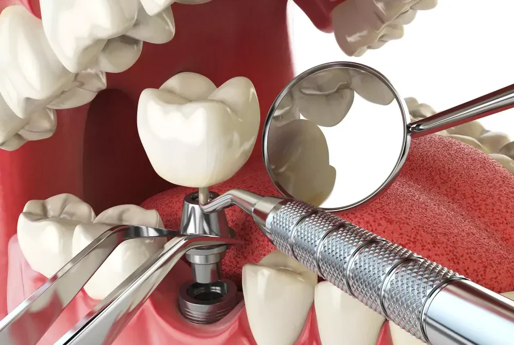 Dental Implants
